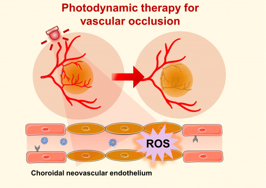 Photodynamic therapy (PDT) offers a clinical solution by utilising non-toxic photosensitisers activated by specific wavelengths of light to generate reactive oxygen species (ROS), which can damage and obliterate neovascularisation.
 